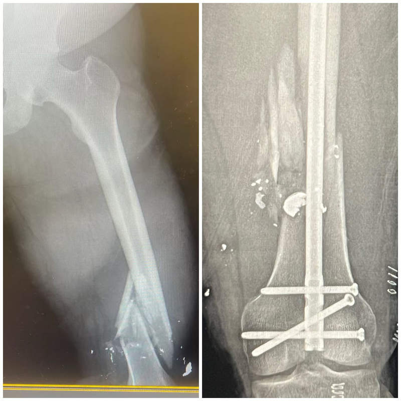 xray fixed injury Orthoedge