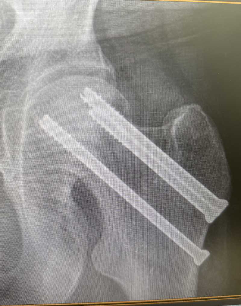 Hip fracture with 3 screws.