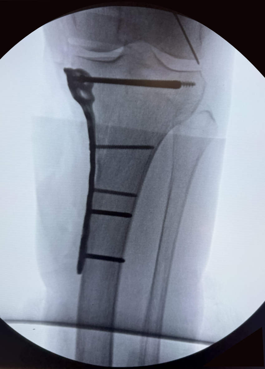 Knee Fracture