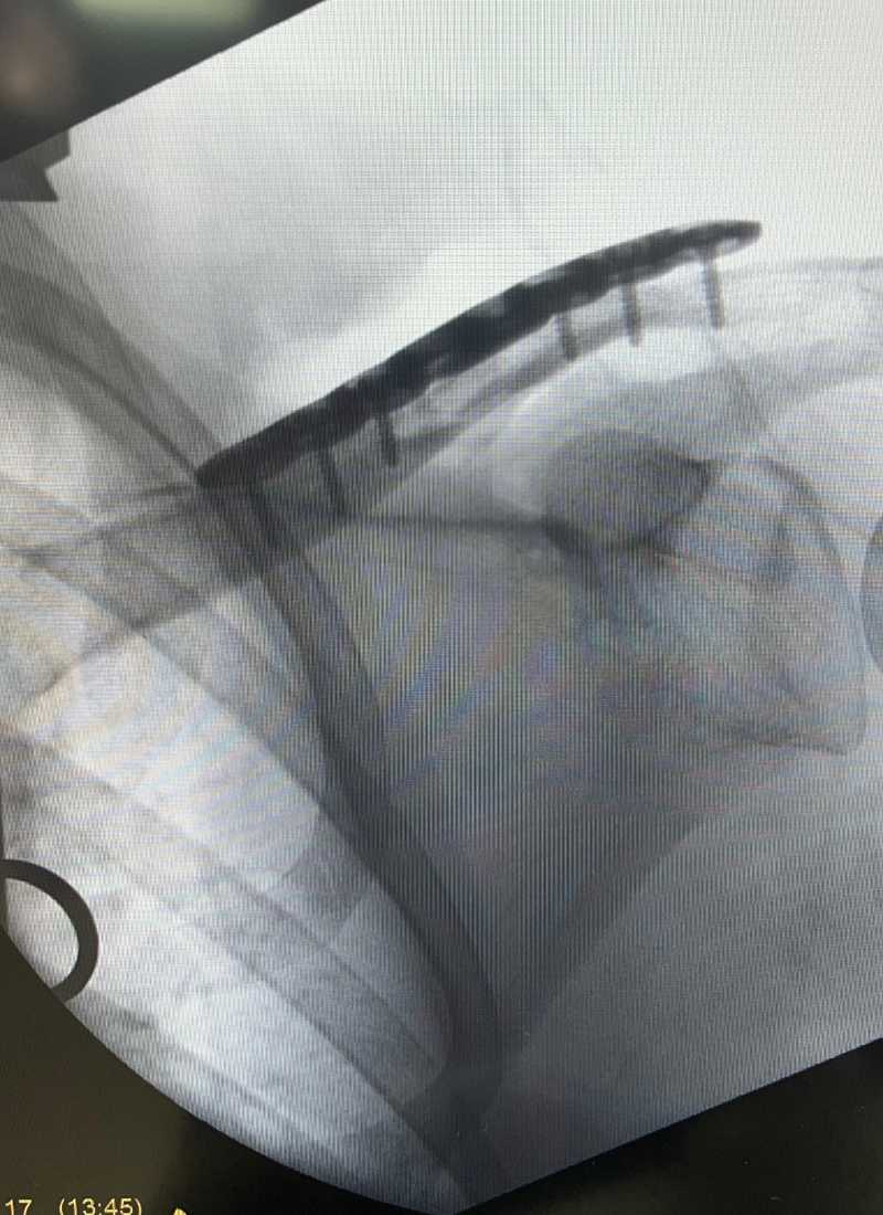 Shoulder Fracture