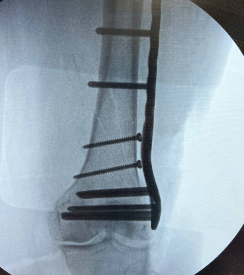 fracture management