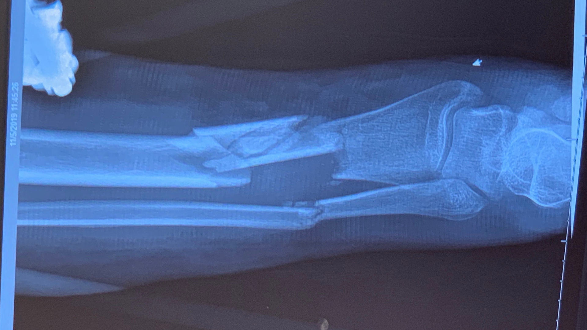Compound Fracture - Orthopedic Surgery required