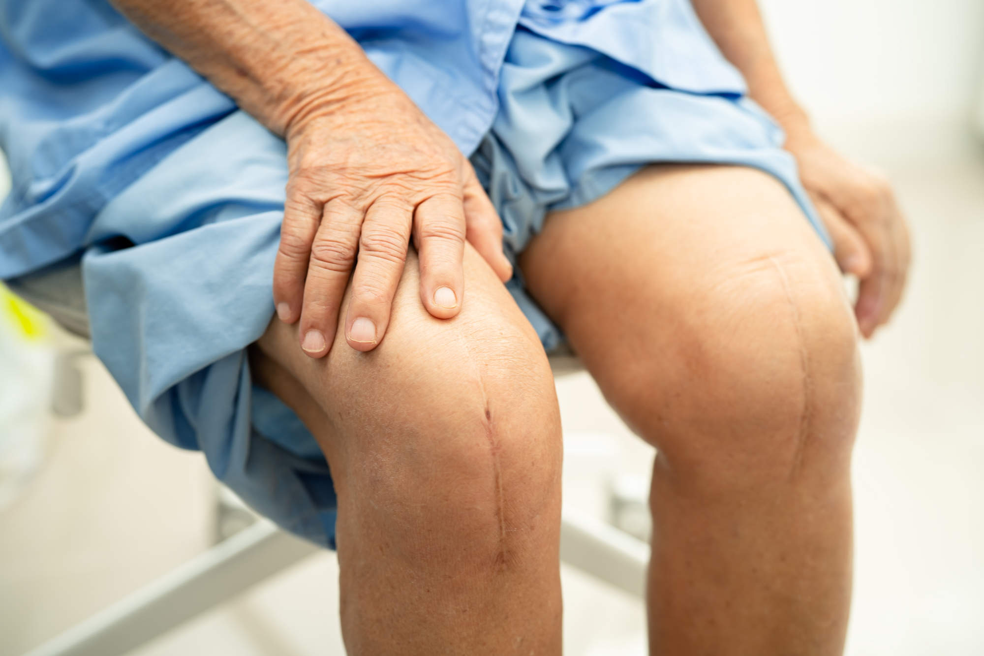 Knee Replacement Surgery